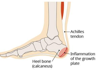 Figure 1: Anatomy of Severs 